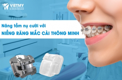 Niềng Răng Mắc Cài Thông Minh: Phương Pháp Niềng Hiện Đại Hiệu Quả